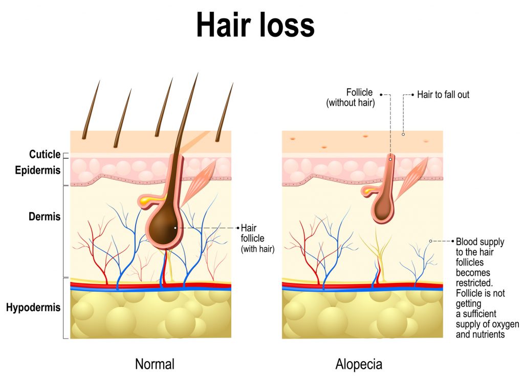 Grafik zur Erklärung von Haarausfall