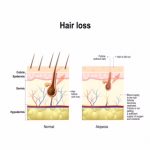 Hair loss, alopecia, baldness